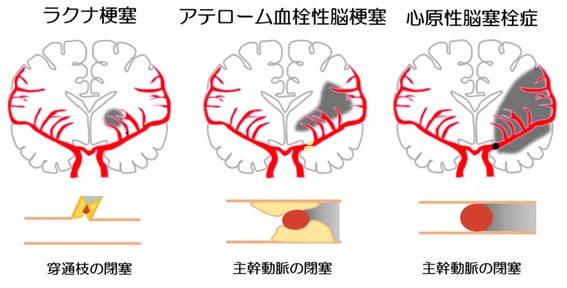 閉塞