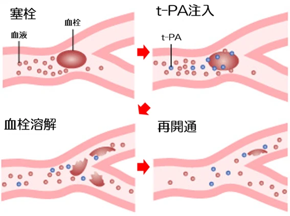 血栓溶解療法